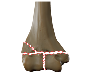 Type C2 distal humerus fracture; by Doctor Jana, CC BY-SA 4.0, via Wikimedia Commons