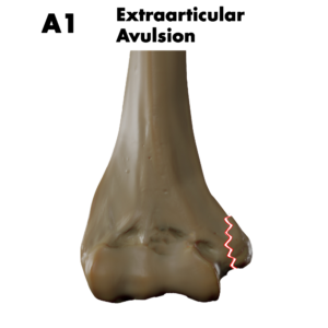 Type A1 distal humerus fracture; by Doctor Jana, CC BY-SA 4.0, via Wikimedia Commons