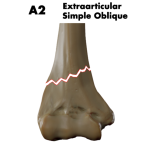 Type A2 distal humerus fracture; by Doctor Jana, CC BY-SA 4.0, via Wikimedia Commons