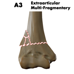 Type A3 distal humerus fracture; by Doctor Jana, CC BY-SA 4.0, via Wikimedia Commons