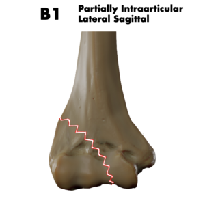 Type B1 distal humerus fracture; by Doctor Jana, CC BY-SA 4.0, via Wikimedia Commons