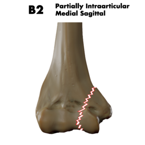 Type B2 distal humerus fracture; by Doctor Jana, CC BY-SA 4.0, via Wikimedia Commons