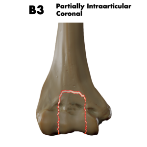 Type B3 distal humerus fracture; by Doctor Jana, CC BY-SA 4.0, via Wikimedia Commons