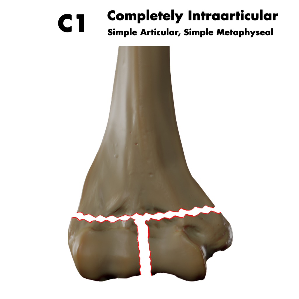 Type C1 distal humerus fracture; by Doctor Jana, CC BY-SA 4.0, via Wikimedia Commons