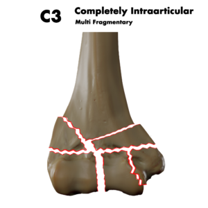 Type C3 distal humerus fracture; by Doctor Jana, CC BY-SA 4.0, via Wikimedia Commons