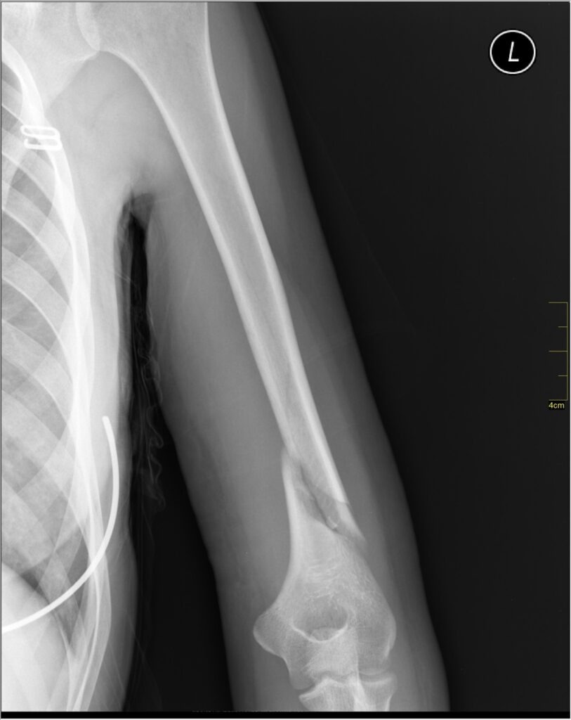 X-ray showing distal humerus fracture; by Nevit Dilmen, CC BY-SA 3.0 <https://creativecommons.org/licenses/by-sa/3.0>, via Wikimedia Commons