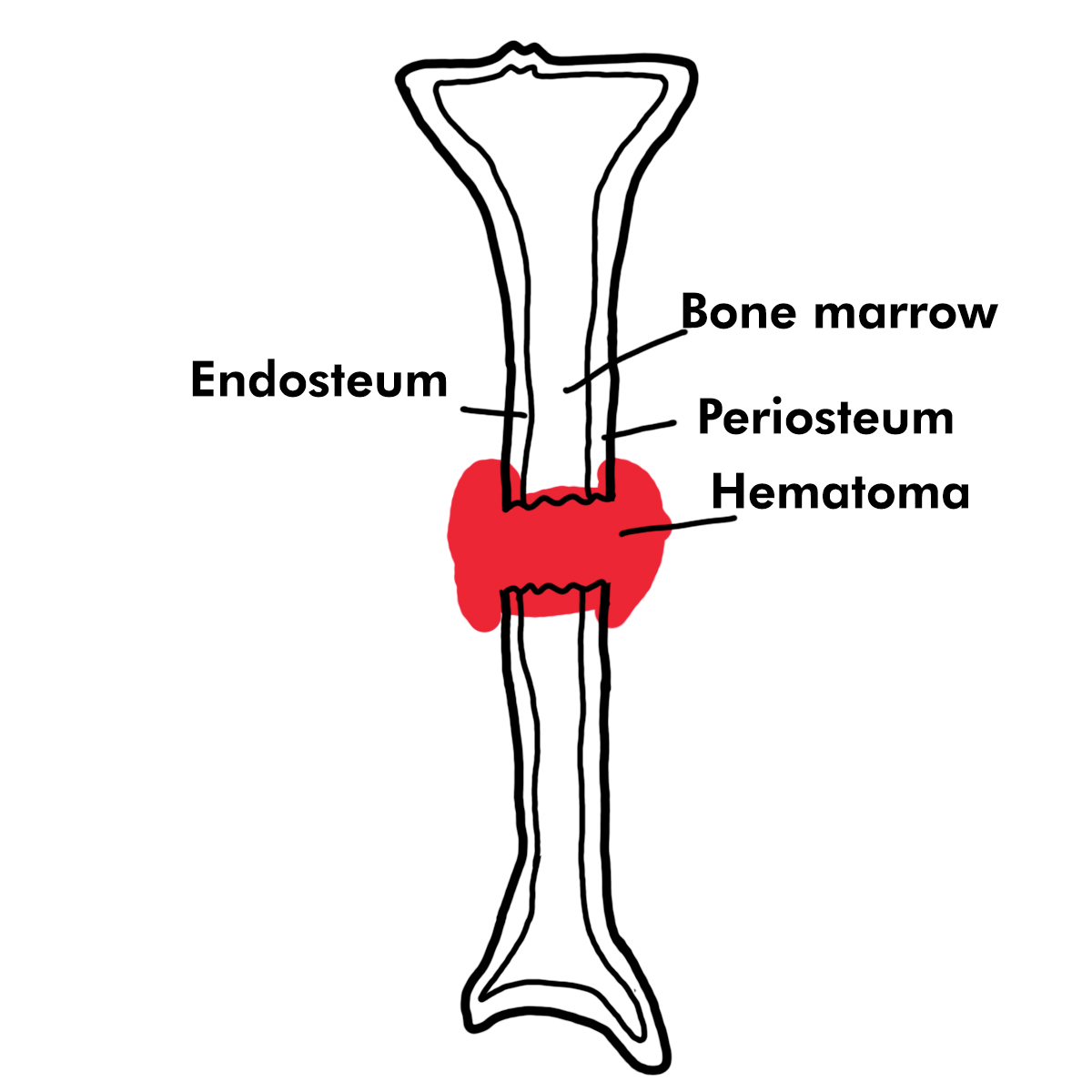 Bone Healing Process Explained in Details - PharmacologyOrthopedics