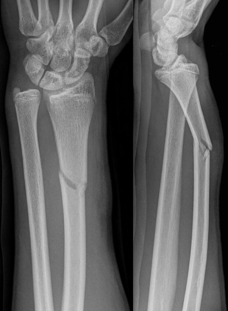 AP and lateral forearm X-rays showing Galeazzi fracture dislocation; by Hellerhoff, CC BY-SA 3.0, via Wikimedia Commons