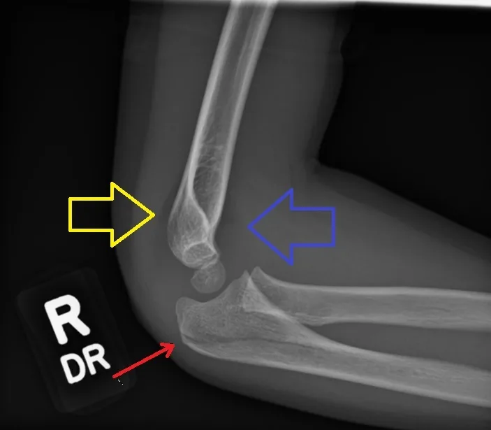 Elevated elbow fat pads annotated by the yellow and blue arrows in a patient with olecranon fracture on a lateral elbow X ray; by Doc James, CC BY-SA 4.0 , via Wikimedia Commons