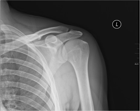 Normal Shoulder X-ray; by Nevit Dilmen, via Wikimedia Commons