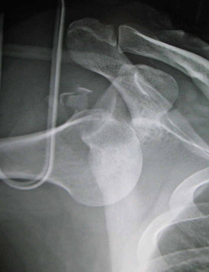 Shoulder AP X-rays showing inferior shoulder dislocation; by James Heilman, via Wikimedia Commons