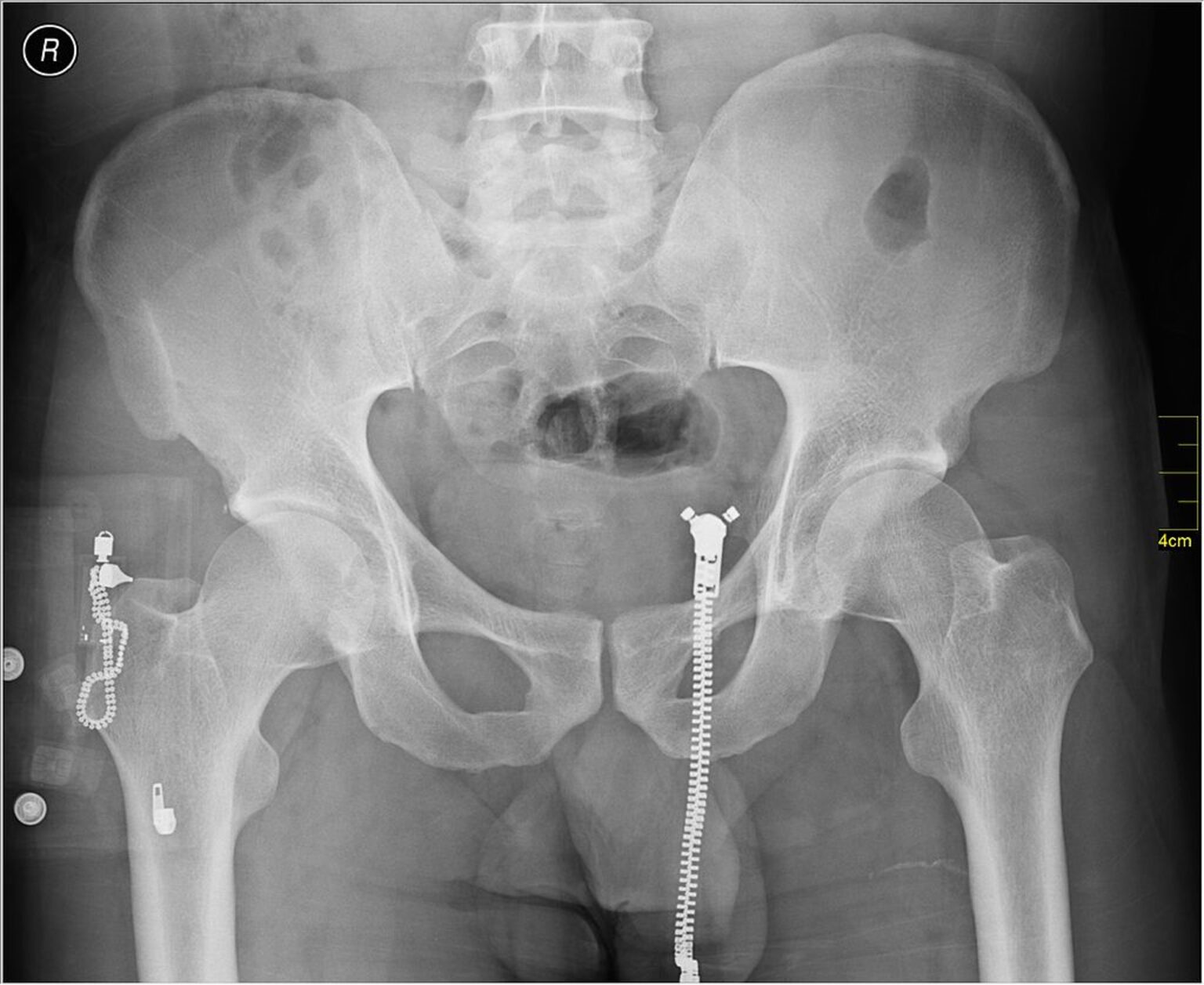 Orthopedic X Ray Interpretation Basics Explained with Examples ...