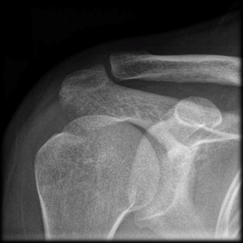 Normal Acromioclavicular joint