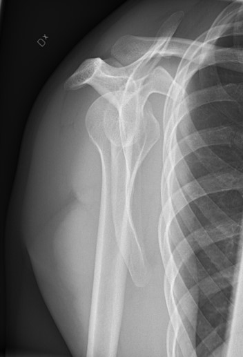 Normal Lateral Shoulder X-Rays; by Mikael Häggström, CC0, via Wikimedia Commons