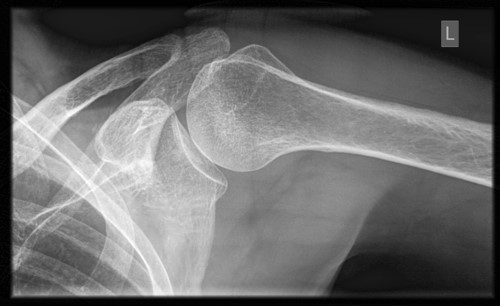 Normal Axial Shoulder X-ray; by RSatUSZ, CC BY-SA 4.0, via Wikimedia Commons