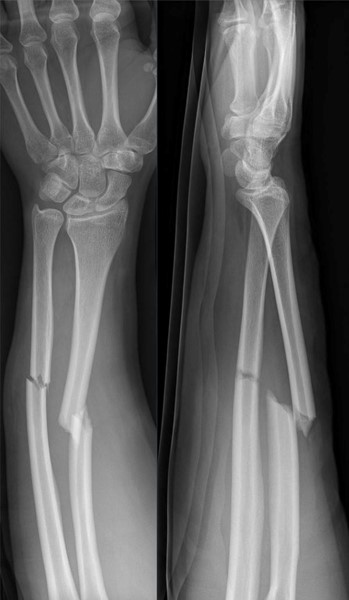 AP and lateral Forearm X-rays showing radius and ulna shaft fractures; by Hellerhoff, CC BY-SA 4.0 <https://creativecommons.org/licenses/by-sa/4.0>, via Wikimedia Commons