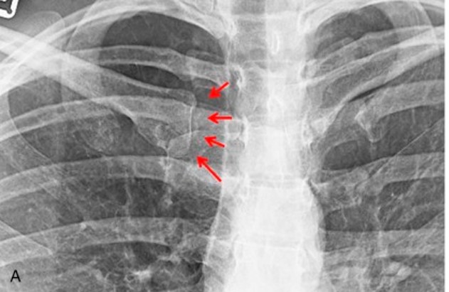 Sternoclavicular joint dislocation and arthritis; by J. Christoph Katthagen, Dimitri S.Tahal, Travis J.Menge, Marilee P. Horan, Peter J.Millett, Public domain, via Wikimedia Commons