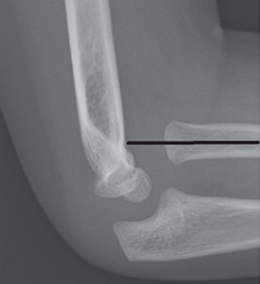 Lateral elbow X-rays showing elbow dislocation; by Tracy Kilborn, Halvani Moodley and Stewart MearsAdded annotations: Mikael Häggström, CC BY-SA 4.0, via Wikimedia Commons