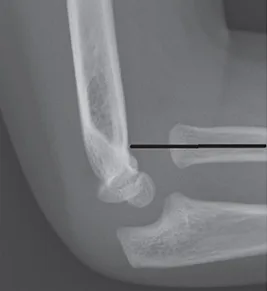 Radiocapitellar line drawn on an lateral elbow x ray for a patient with divergent elbow dislocation; by Tracy Kilborn, Halvani Moodley and Stewart Mears; Added annotations by: Mikael Häggström, CC BY-SA 4.0 , via Wikimedia Commons