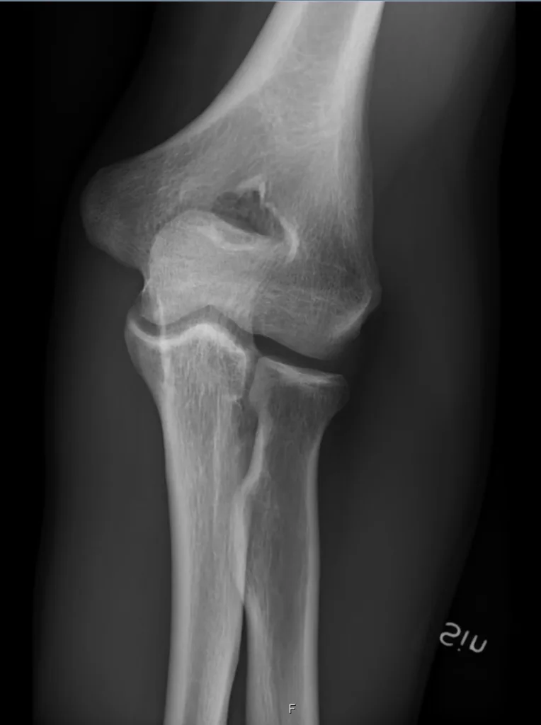 Normal AP Elbow X-ray; by Mikael Häggström, M.D., CC0, via Wikimedia Commons