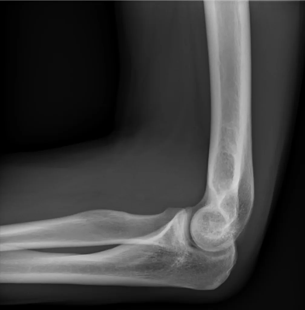 Normal Lateral Elbow X-ray; by Mikael Häggström, M.D., CC0, via Wikimedia Commons